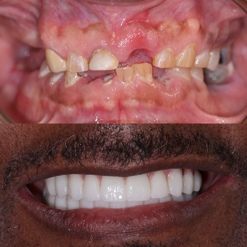 Patient smile before and after treatment